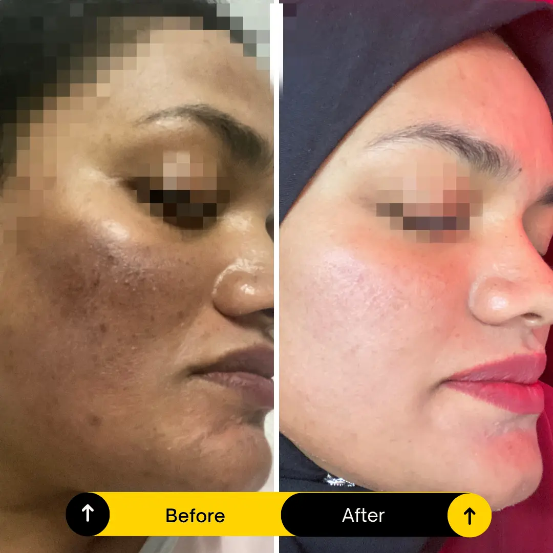 Pigmentation