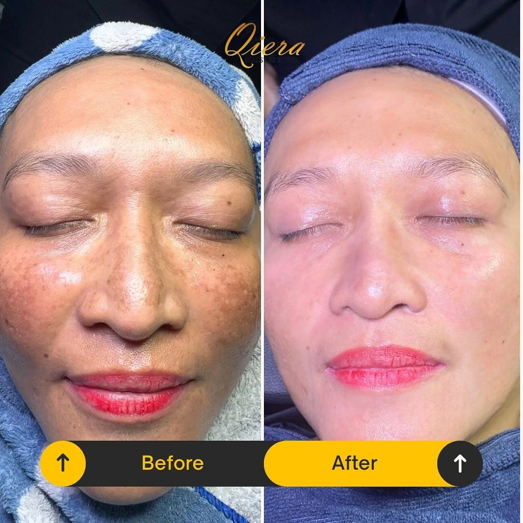 Pigmentation