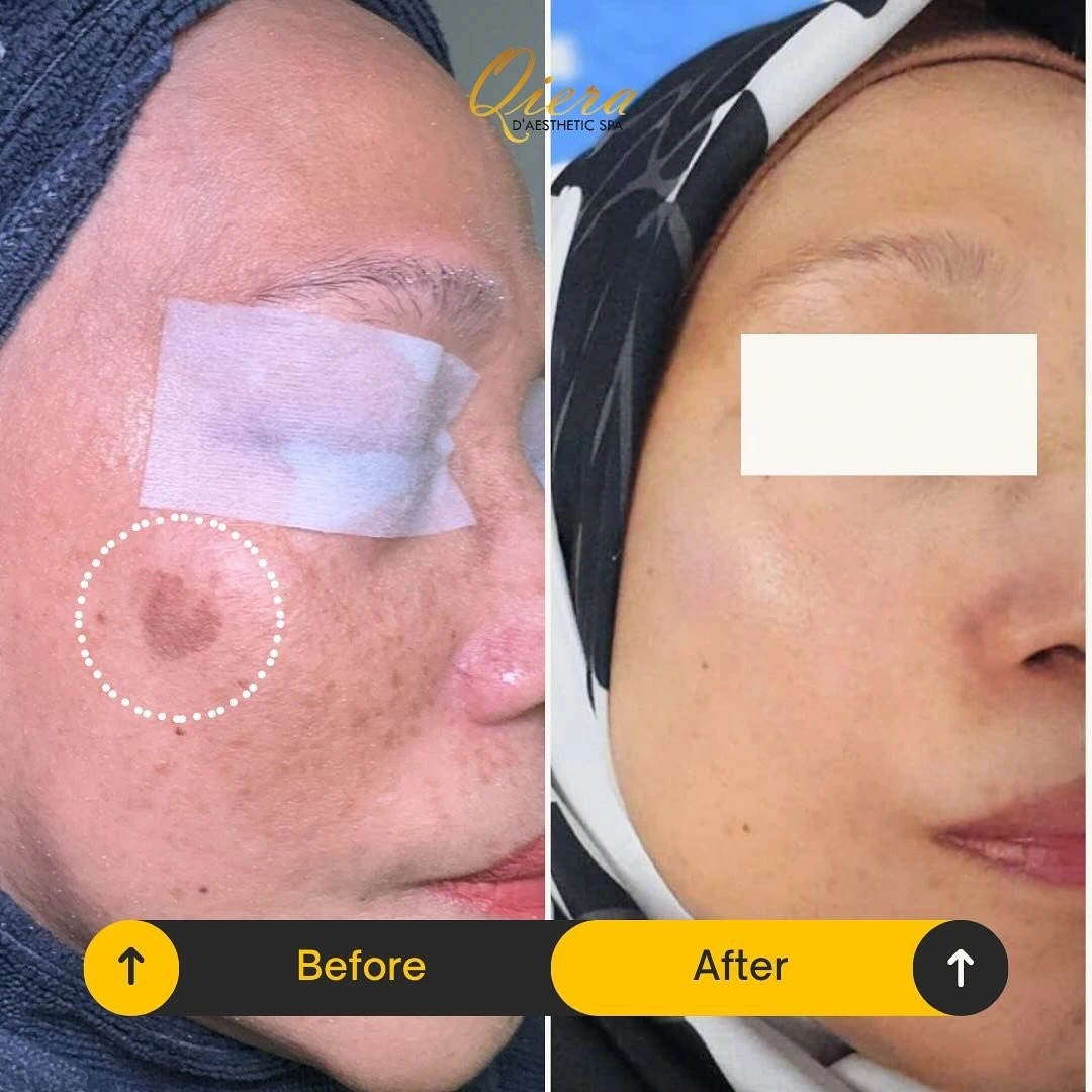Pigmentation