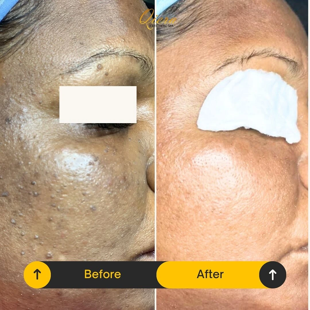 Pigmentation