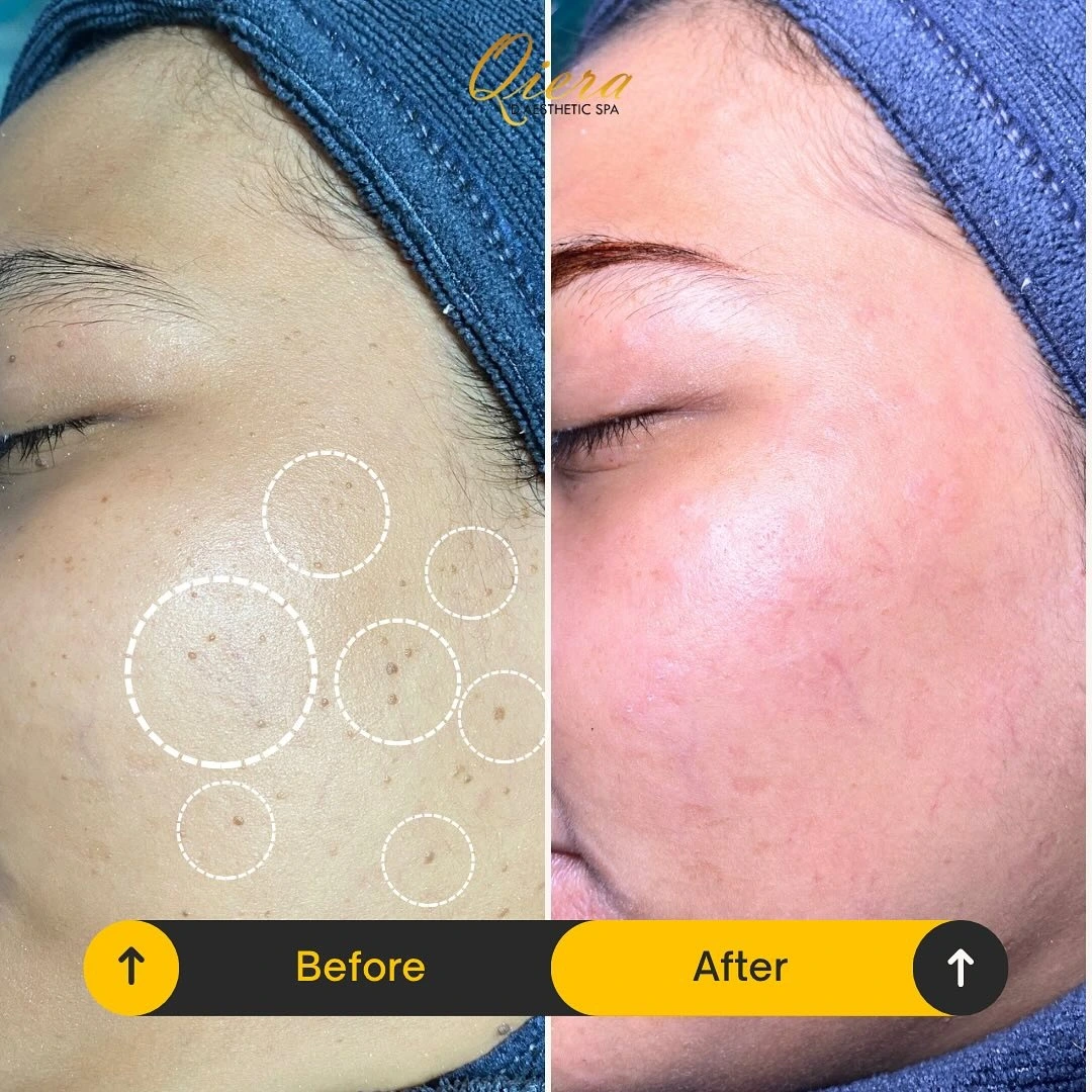 Skintag Removal