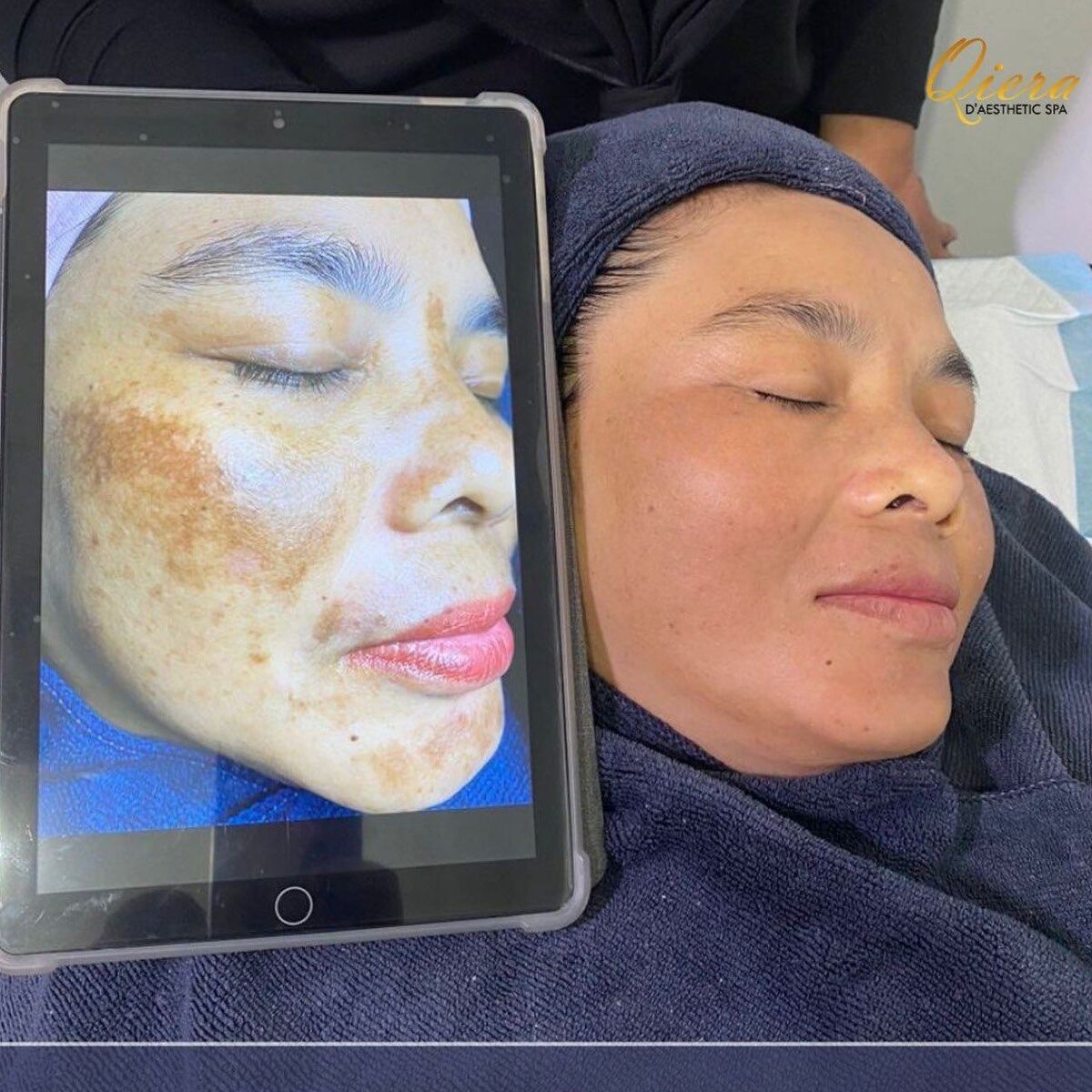Pigmentation